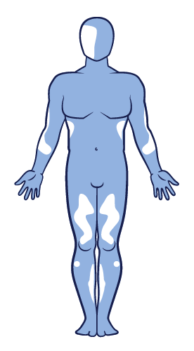 Image showing the distribution of mixed-type vitiligo on the body.